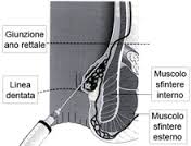 Terapia emorroidi